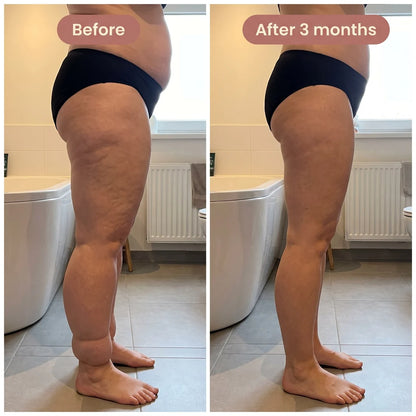 Sira Sculpt 4D Lipedema Leggings